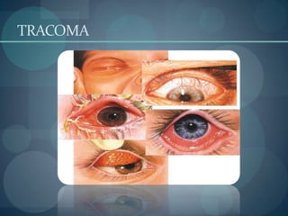 TRACOMA
 