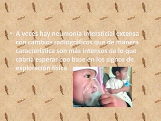 • A veces hay neumonía intersticial extensa
  con cambios radiográficos que de manera
  característica son más intensos de lo que
  cabría esperar con base en los signos de
  exploración física
 