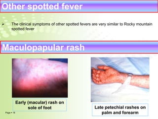 Other spotted fever 
 The clinical symptoms of other spotted fevers are very similar to Rocky mountain 
spotted fever 
Maculopapular rash 
Page  18 
Late petechial rashes on 
palm and forearm 
Early (macular) rash on 
sole of foot 
 
