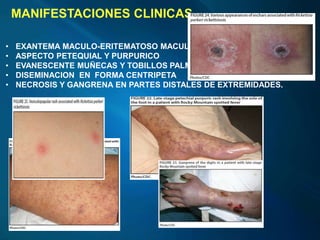 MANIFESTACIONES CLINICAS
• EXANTEMA MACULO-ERITEMATOSO MACULO PAPULAR
• ASPECTO PETEQUIAL Y PURPURICO
• EVANESCENTE MUÑECAS Y TOBILLOS PALMAS Y PLANTAS
• DISEMINACION EN FORMA CENTRIPETA
• NECROSIS Y GANGRENA EN PARTES DISTALES DE EXTREMIDADES.
 
