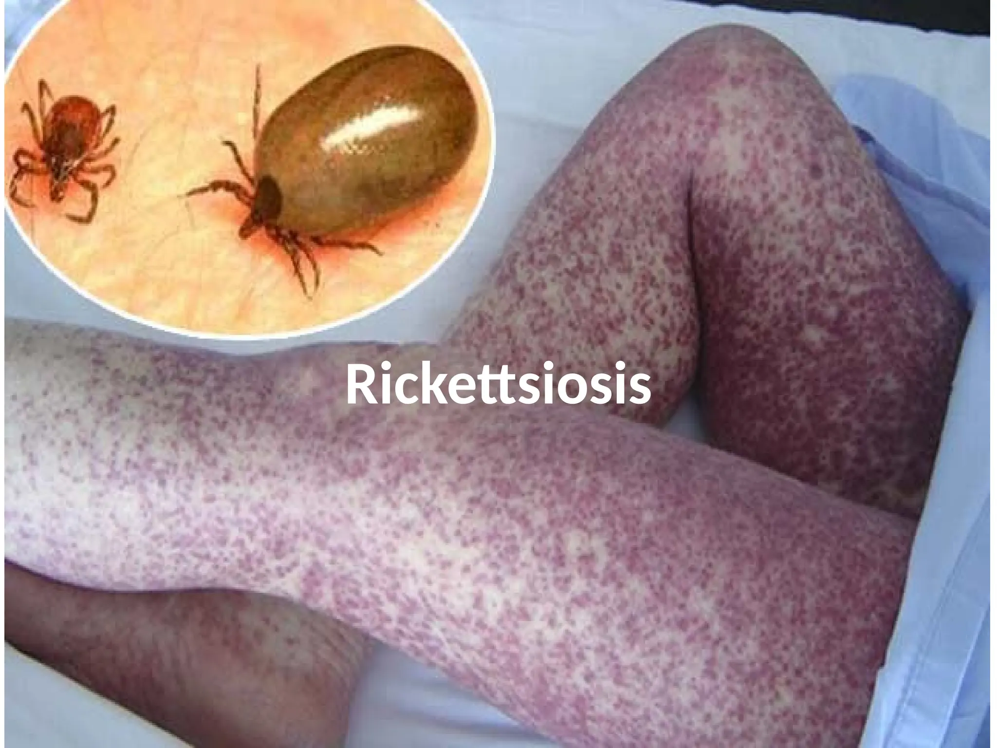 Rickettsiosis fiebre de las montañas rocosas.pptx