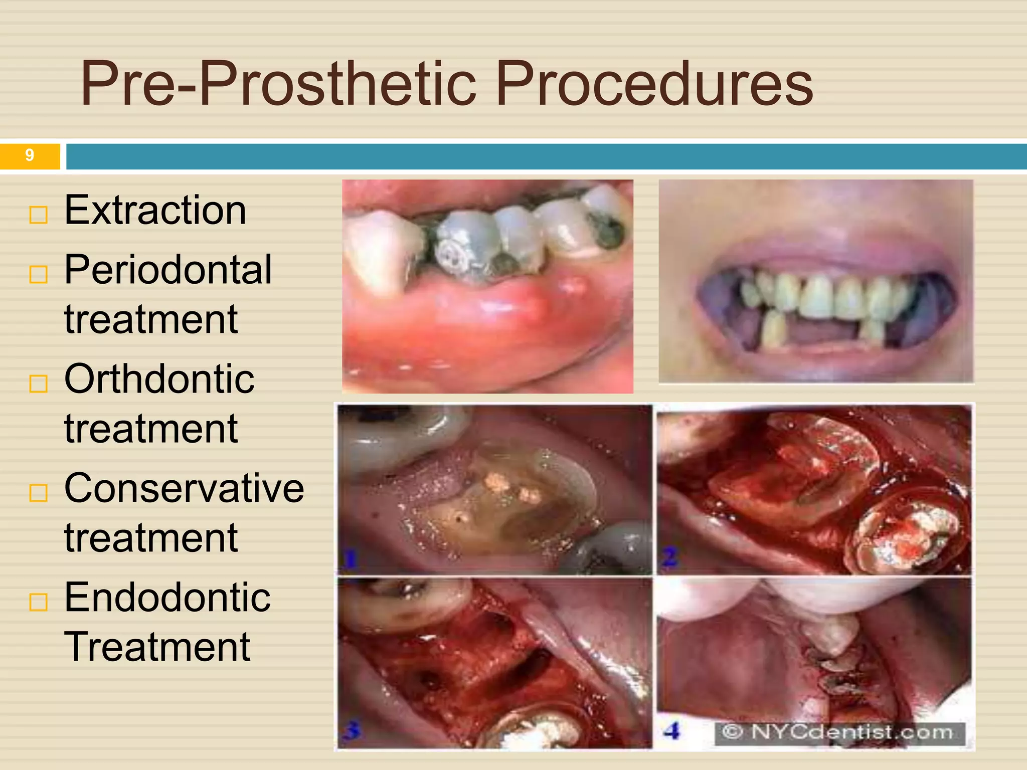 Pre-Prosthetic Procedures
 Extraction
 Periodontal
treatment
 Orthdontic
treatment
 Conservative
treatment
 Endodontic
Treatment
9
 