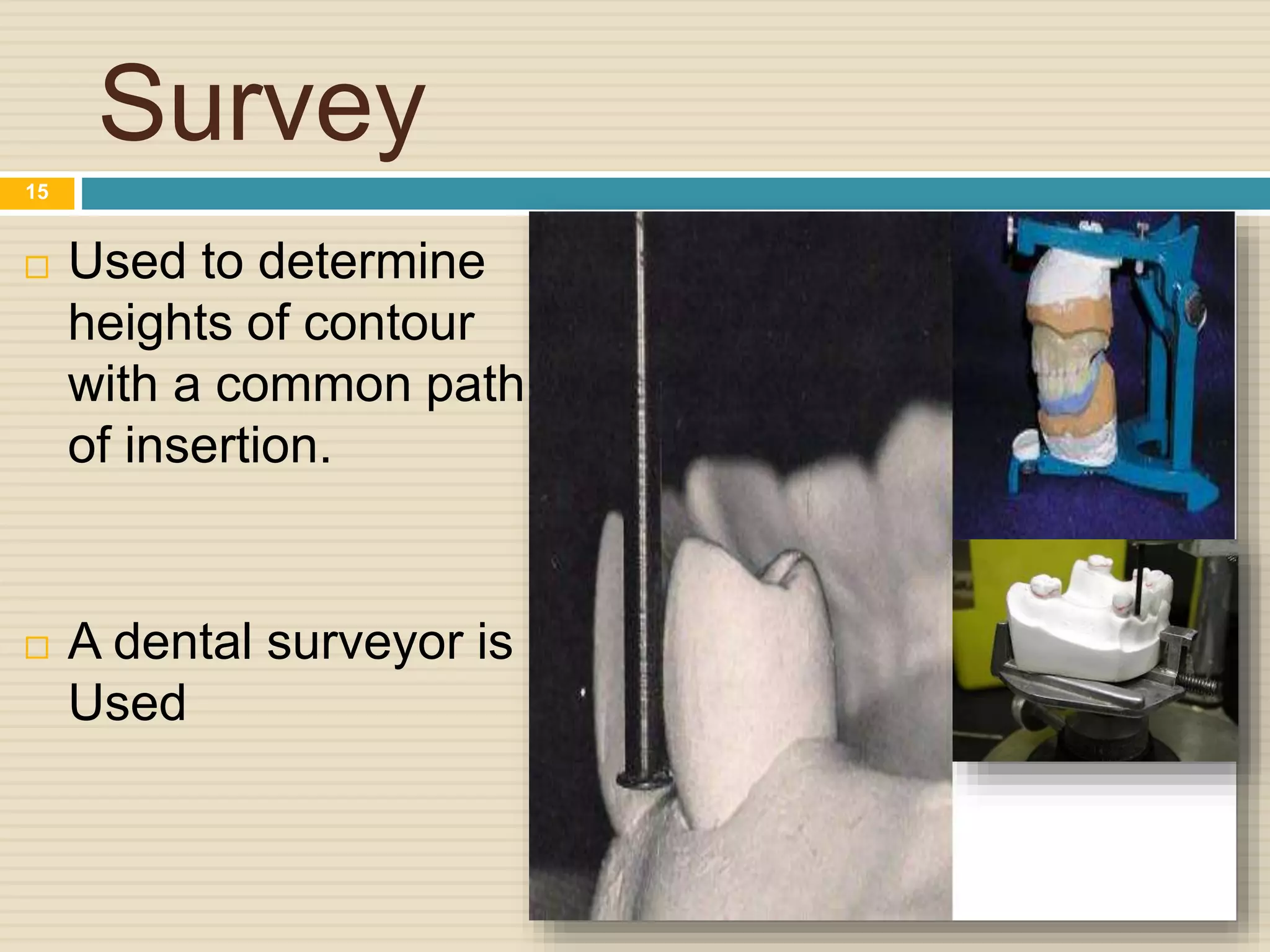 Survey
 Used to determine
heights of contour
with a common path
of insertion.
 A dental surveyor is
Used
15
 