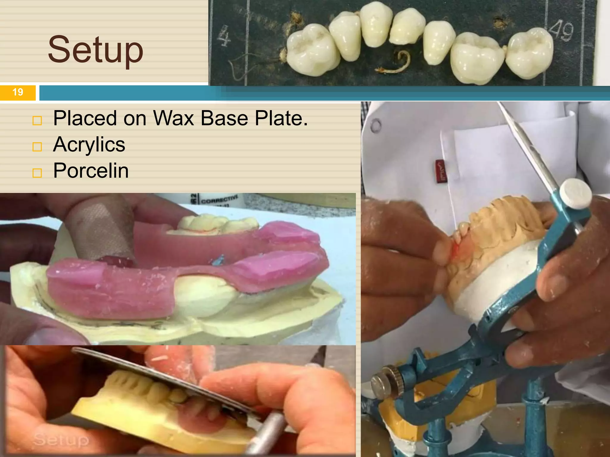 Setup
 Placed on Wax Base Plate.
 Acrylics
 Porcelin
19
 