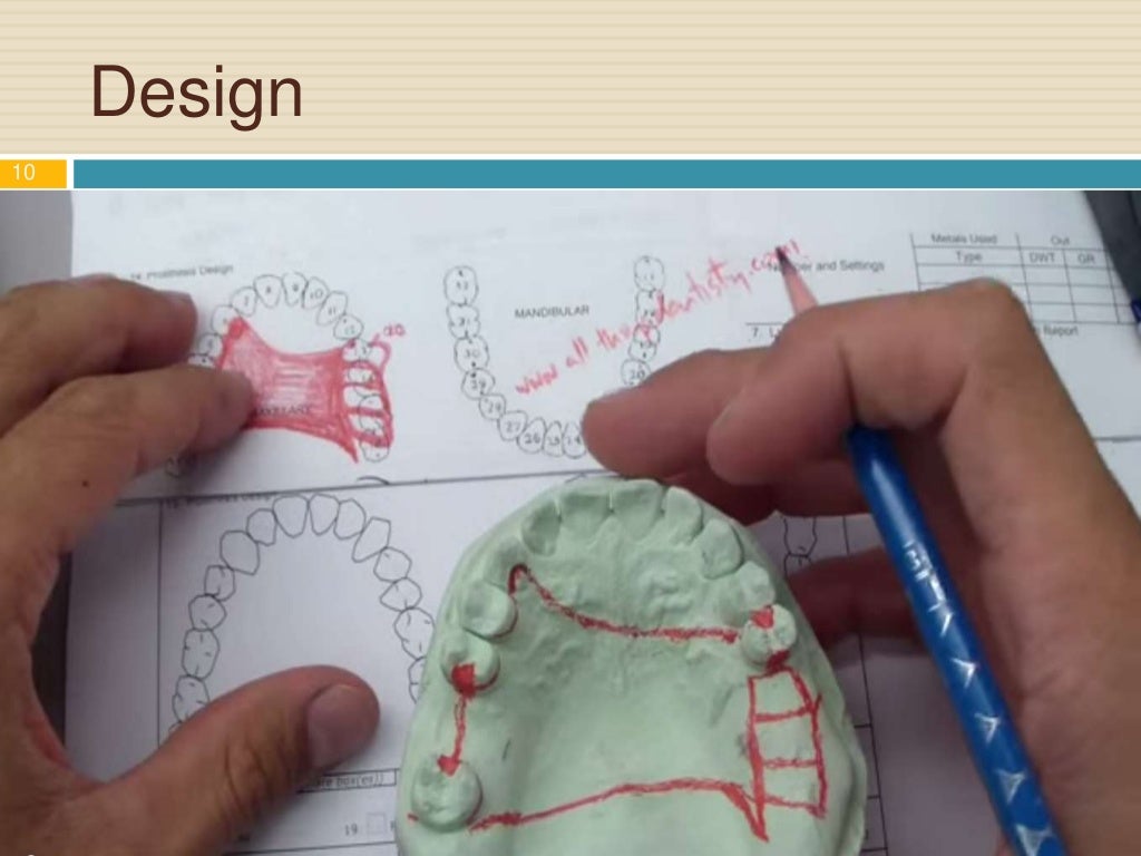 Steps of Fabrication of Removable Partial Denture