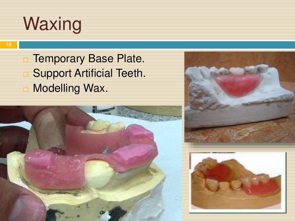 Steps of Fabrication of Removable Partial Denture