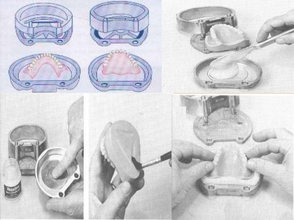 Steps of Fabrication of Removable Partial Denture