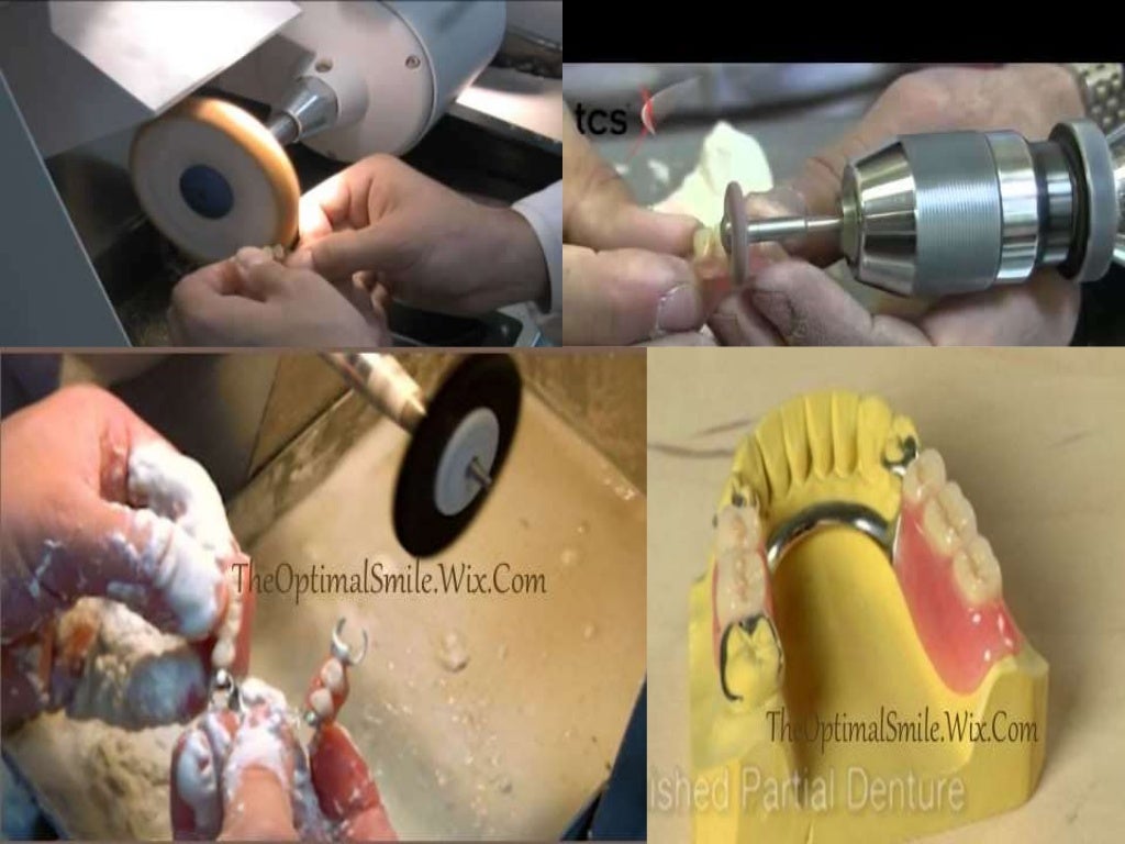 Steps of Fabrication of Removable Partial Denture