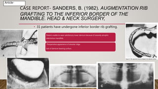 CASE REPORT- SANDERS, B. (1982). AUGMENTATION RIB
GRAFTING TO THE INFERIOR BORDER OF THE
MANDIBLE. HEAD & NECK SURGERY,
• 31 patients have undergone inferior border rib grafting.
Sanders, B. (1982). Augmentation rib grafting to the inferior border of the mandible. Head & Neck
Article-
Patient unable to wear satisfactory lower denture because of severely atrophic
edentulous mandible.
Preoperative appearance of alveolar ridge.
lack of denture-bearing surface.
 