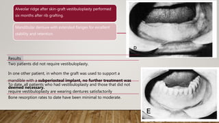 Alveolar ridge after skin-graft vestibuloplasty performed
six months after rib grafting.
Mandibular denture with extended flanges for excellent
stability and retention.
Results
Two patients did not require vestibuloplasty.
In one other patient, in whom the graft was used to support a
mandible with a subperiosteal implant, no further treatment was
deemed necessary.
To date, all patients who had vestibuloplasty and those that did not
require vestibuloplasty are wearing dentures satisfactorily
Bone resorption rates to date have been minimal to moderate.
 