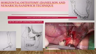 HORIZONTALOSTEOTOMY (DANIELSON AND
NEMARICH)/SANDWICH TECHNIQUE
Splitting of maxilla and mandible bone is grafted into osteotomy gap
Can be used with osteointegrated implant
Tucker, R.M. Ambulatory Preprosthetic Reconstructive Surgery
 