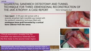 SEGMENTAL SANDWICH OSTEOTOMY AND TUNNEL
TECHNIQUE FOR THREE-DIMENSIONAL RECONSTRUCTION OF
THE JAW ATROPHY: A CASE REPORT
• Case report - A 59-year-old woman with a
severely atrophied right mandible was treated with
the sandwich osteotomy technique filled with
autologous bone graft harvested by a cortical
bone collector from the ramus.
International Journal of Implant Dentistry
Mario Santagata et.al
Article
Clinical examination revealed that the
mandible was edentulous bilaterally from
the first molar to the second molar region.
Radiographically, atrophy of the mandibular alveolar ridge in
the same teeth site was observed- began to treat the right side.
 