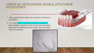 VERTICAL OSTEOTOMY (HARLE,1975)/VISOR
OSTEOTOMY
1. Was originated by Harle and modified by Peterson
and Slade.
2. It is used where insufficient vertical mandibular
bone height is present for the horizontal osteotomy
technique but adequate bone width (approximately
10mm) is present.
Tucker, R.M. Ambulatory Preprosthetic Reconstructive Surgery
 
