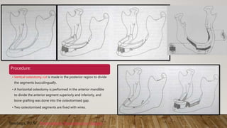 Procedure:
• Vertical osteotomy cut is made in the posterior region to divide
the segments buccolingually.
• A horizontal osteotomy is performed in the anterior mandible
to divide the anterior segment superiorly and inferiorly, and
bone grafting was done into the osteotomised gap.
• Two osteotomised segments are fixed with wires.
Stoelinga, P.J.W. Preprosthetic Reconstructive Surgery.
 