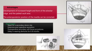 • Advantages
Development of increased height and form of the alveolar
ridge and the palatal vault area.
The anteroposterior position of the maxilla can be corrected.
Disadvantages
Need for a secondary donor site.
Extensive post operative resorption.
Postoperative secondary soft tissue procedures.
Delay in wearing dentures for 6-8 months
 