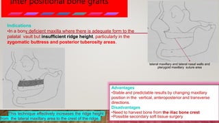 Inter positional bone grafts
Indications
•In a bony deficient maxilla where there is adequate form to the
palatal vault but insufficient ridge height, particularly in the
zygomatic buttress and posterior tuberosity areas.
Advantages
•Stable and predictable results by changing maxillary
position in the vertical, anteroposterior and transverse
directions.
Disadvantages
•Need to harvest bone from the iliac bone crest
•Possible secondary soft tissue surgery
This technique effectively increases the ridge height
from the lateral maxillary area to the crest of the ridge.
lateral maxillary and lateral nasal walls and
pterygoid maxillary suture area
 