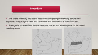 Procedure
• The lateral maxillary and lateral nasal walls and pterygoid maxillary suture area
separated using surgical saws and osteotome and the maxilla is down fractured.
• Bone grafts obtained from the iliac crest are shaped and wired in place in the lateral
maxillary areas.
 