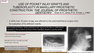 USE OF POCKET INLAY GRAFTS AND
TUBEROPLASTY IN MAXILLARY PROSTHETIC
CONSTRUCTION. THE JOURNAL OF PROSTHETIC
DENTISTRY.
• A white man, 59 years of age, was referred to the oral/maxillofacial surgery clinic
for evaluation of his deficient maxilla.
Gross, B. D., James, R. B., & Fister, J. (1980).
Article
Past medical history- had sustained a war injury to his face in 1944 which
resulted in the avulsion of most of the maxillary alveolus and the entire
hard palate
Physical examination was unremarkable,
except for the intraoral findings.
Bilaterally, there was no clinically discernable
alveolar ridge or tuberosity.
Palpation revealed only a rim of bone in the
area of the lateral wall of the maxillary sinus.
 