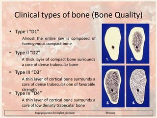 Ridge preparation for implant placement - part 1 | PPTX