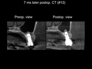 7 ms later postop. CT (#12)

Preop. view

Postop. view

 