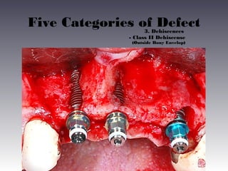 Five Categories of Defect
3. Dehiscences
- Class II Dehiscense
(Outside Bony Envelop)

 