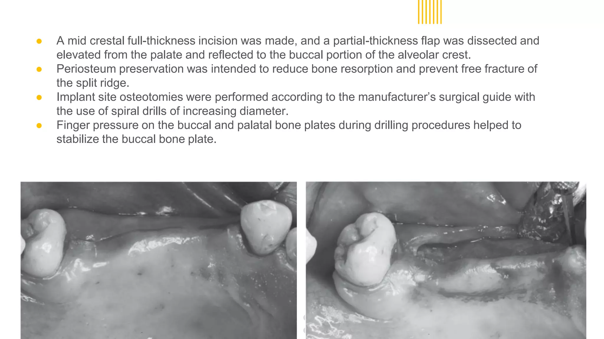 ● A mid crestal full-thickness incision was made, and a partial-thickness flap was dissected and
elevated from the palate and reflected to the buccal portion of the alveolar crest.
● Periosteum preservation was intended to reduce bone resorption and prevent free fracture of
the split ridge.
● Implant site osteotomies were performed according to the manufacturer’s surgical guide with
the use of spiral drills of increasing diameter.
● Finger pressure on the buccal and palatal bone plates during drilling procedures helped to
stabilize the buccal bone plate.
 