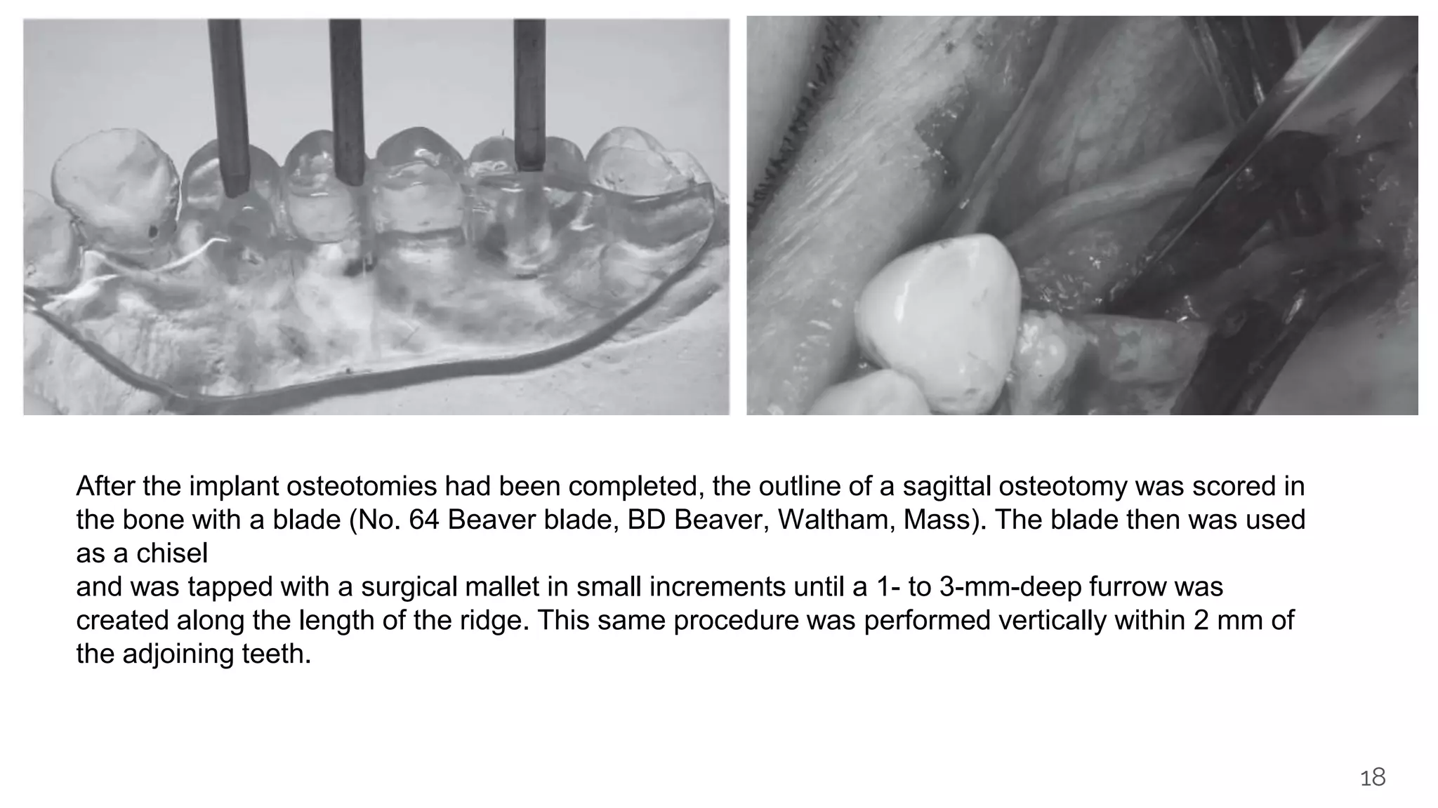 18
After the implant osteotomies had been completed, the outline of a sagittal osteotomy was scored in
the bone with a blade (No. 64 Beaver blade, BD Beaver, Waltham, Mass). The blade then was used
as a chisel
and was tapped with a surgical mallet in small increments until a 1- to 3-mm-deep furrow was
created along the length of the ridge. This same procedure was performed vertically within 2 mm of
the adjoining teeth.
 