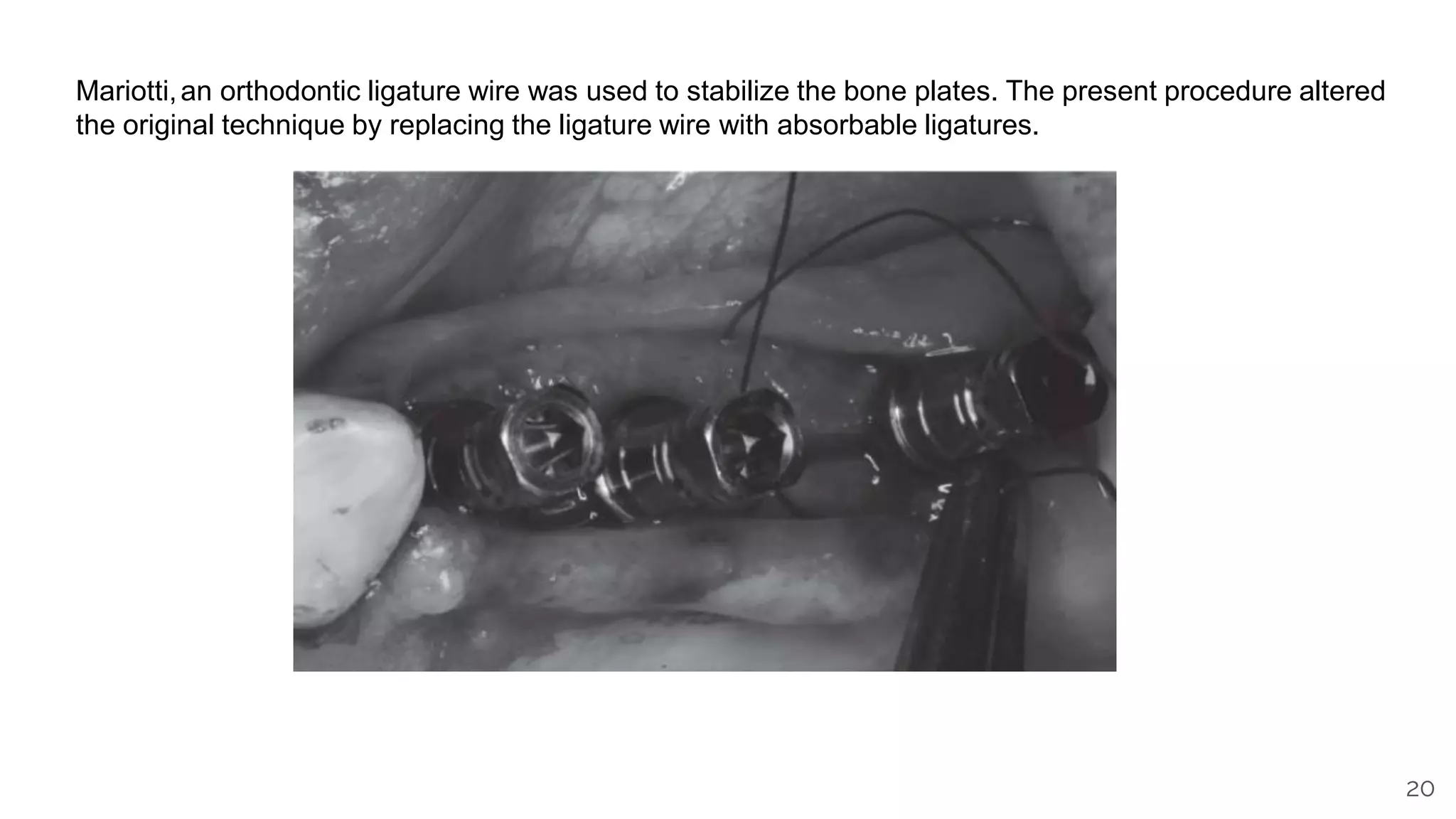 20
Mariotti,an orthodontic ligature wire was used to stabilize the bone plates. The present procedure altered
the original technique by replacing the ligature wire with absorbable ligatures.
 