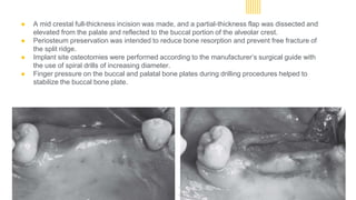 ● A mid crestal full-thickness incision was made, and a partial-thickness flap was dissected and
elevated from the palate and reflected to the buccal portion of the alveolar crest.
● Periosteum preservation was intended to reduce bone resorption and prevent free fracture of
the split ridge.
● Implant site osteotomies were performed according to the manufacturer’s surgical guide with
the use of spiral drills of increasing diameter.
● Finger pressure on the buccal and palatal bone plates during drilling procedures helped to
stabilize the buccal bone plate.
 