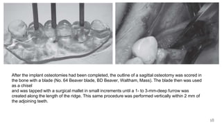 18
After the implant osteotomies had been completed, the outline of a sagittal osteotomy was scored in
the bone with a blade (No. 64 Beaver blade, BD Beaver, Waltham, Mass). The blade then was used
as a chisel
and was tapped with a surgical mallet in small increments until a 1- to 3-mm-deep furrow was
created along the length of the ridge. This same procedure was performed vertically within 2 mm of
the adjoining teeth.
 