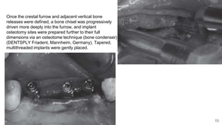 19
Once the crestal furrow and adjacent vertical bone
releases were defined, a bone chisel was progressively
driven more deeply into the furrow, and implant
osteotomy sites were prepared further to their full
dimensions via an osteotome technique (bone condenser)
(DENTSPLY Friadent, Mannheim, Germany). Tapered,
multithreaded implants were gently placed.
 