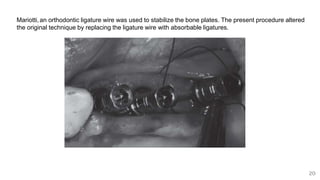 20
Mariotti,an orthodontic ligature wire was used to stabilize the bone plates. The present procedure altered
the original technique by replacing the ligature wire with absorbable ligatures.
 