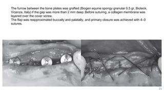 21
The furrow between the bone plates was grafted (Biogen equine spongy granular 0.5 gr, Bioteck,
Vicenza, Italy) if the gap was more than 2 mm deep. Before suturing, a collagen membrane was
layered over the cover screw.
The flap was reapproximated buccally and palatally, and primary closure was achieved with 4–0
sutures.
 