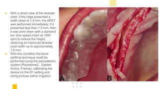 ● With a direct view of the alveolar
crest, if the ridge presented a
width close to 1.5 mm, the ARST
was performed immediately; if it
presented less than 1.5 mm, then
it was worn down with a diamond
bur (low speed motor at 1800
rpm) to reduce the height,
obtaining an improved alveolar
crest width up to approximately
1.5 mm.
● With this condition the bone
splitting technique could be
performed using the piezoelectric
system (Piezotome2¨, Satelec
Action, France), calibrating the
device on the D1 setting and
using profuse saline irrigation.
 