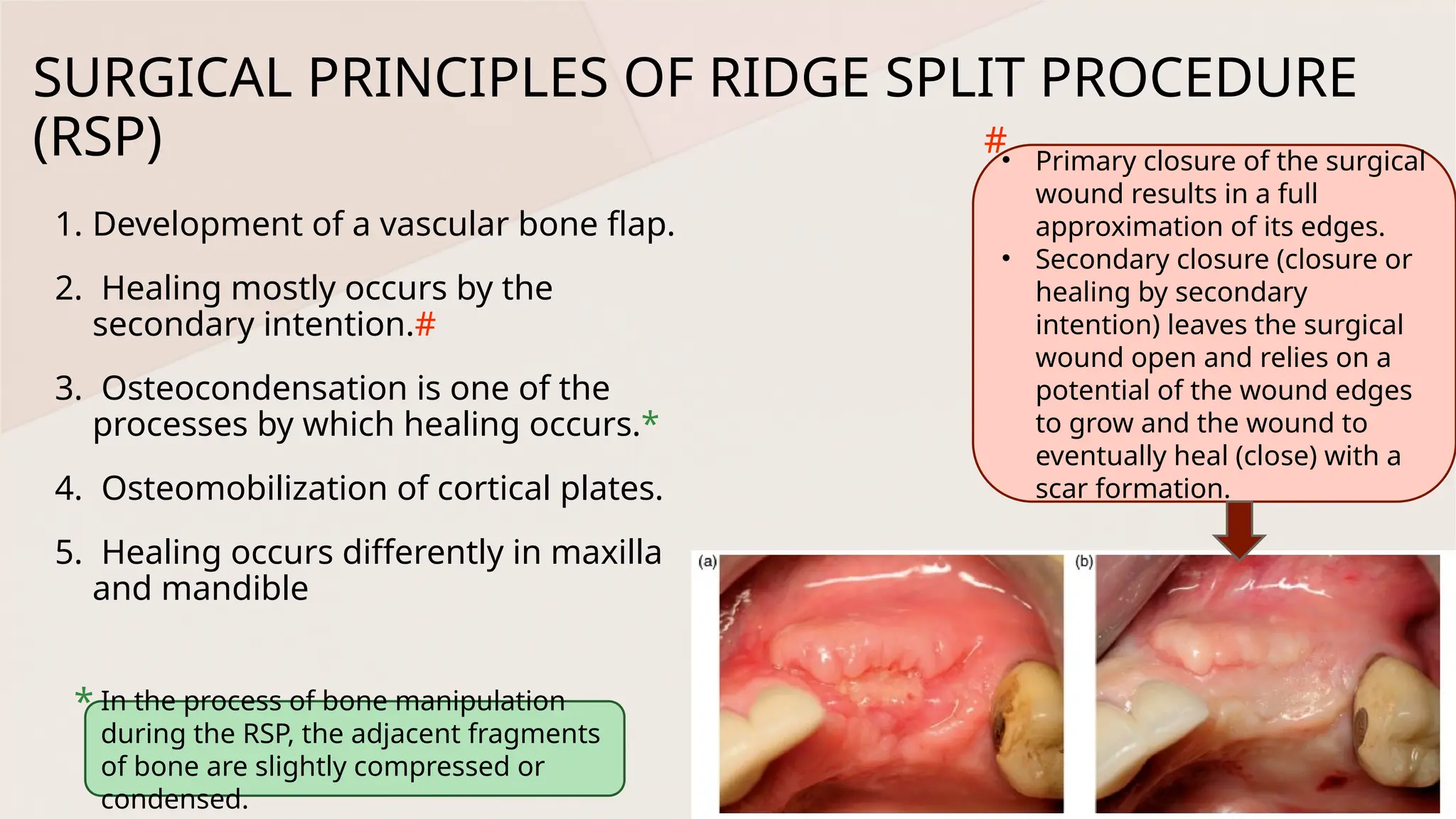 Split Ridge Ring Ridge Split Techniques in Prosthodontics: Enhancing Alveolar Ridge for ...