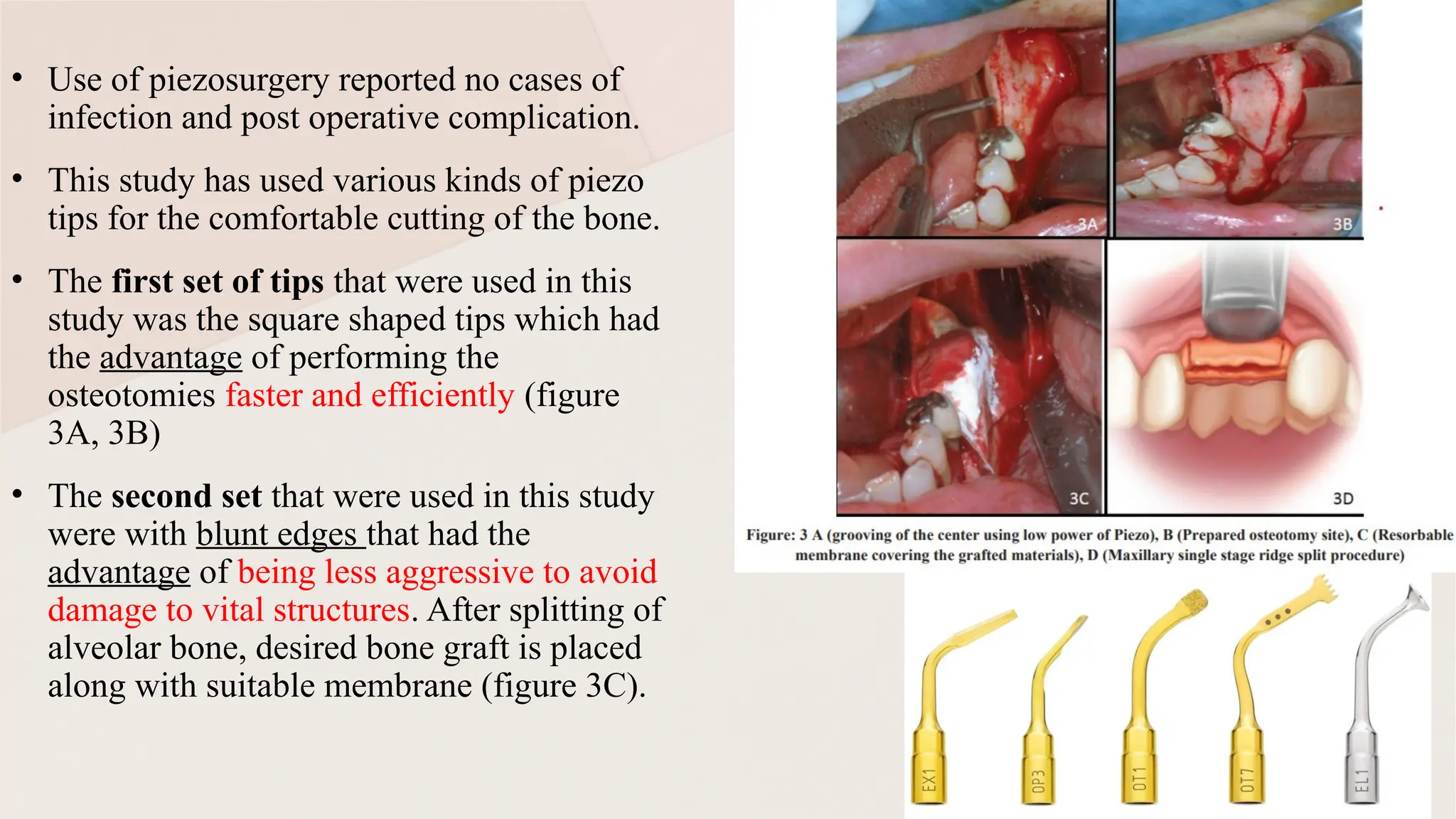 Ridge Split Techniques in Prosthodontics: Enhancing Alveolar Ridge for ...