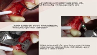 Ridge Split Techniques in Prosthodontics: Enhancing Alveolar Ridge for ...