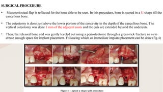 Ridge Split Techniques in Prosthodontics: Enhancing Alveolar Ridge for ...