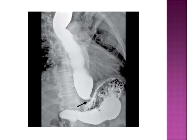 Esophagus : Benign and Malignant diseases | PPTX