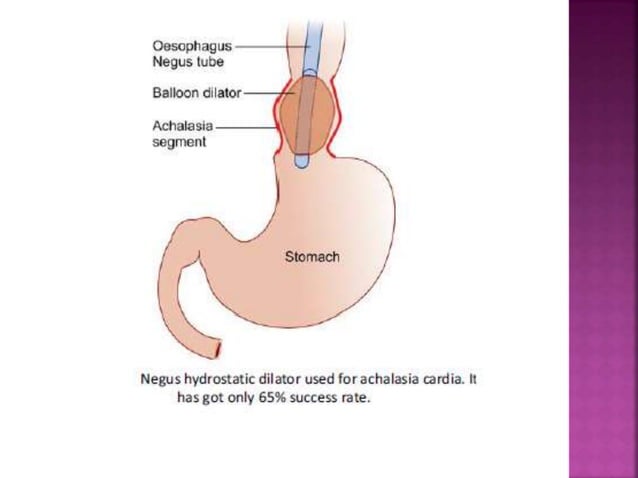 Esophagus : Benign and Malignant diseases | PPTX