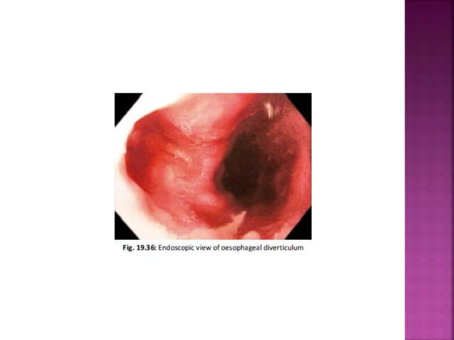 Esophagus : Benign and Malignant diseases | PPTX