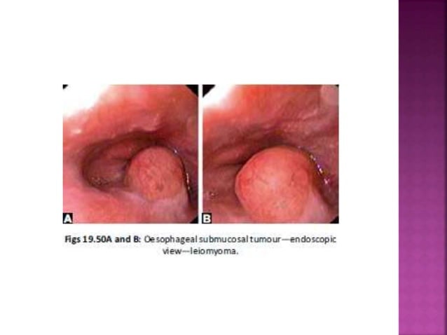 Esophagus : Benign and Malignant diseases | PPTX