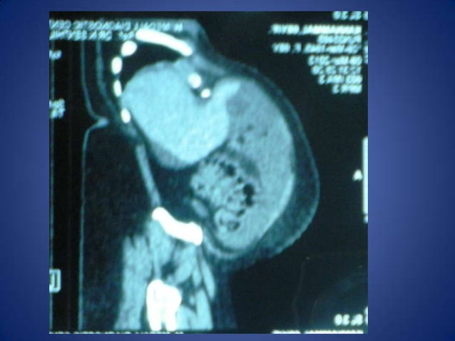 Riedel’s lobe of liver | PPTX | Medical Health