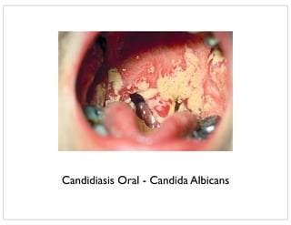 Candidiasis Oral - Candida Albicans
 