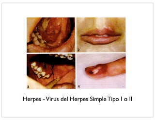 Herpes - Virus del Herpes Simple Tipo I o II
 