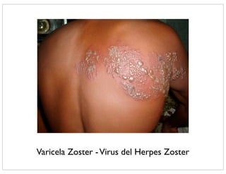 Varicela Zoster - Virus del Herpes Zoster
 