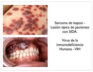 Sarcoma de kaposi -
Lesión típica de pacientes
        con SIDA.

      Virus de la
   inmunodeﬁciencia
     Humana - VIH
 