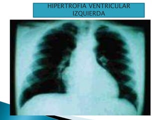 HIPERTROFIA VENTRICULAR
IZQUIERDA
 