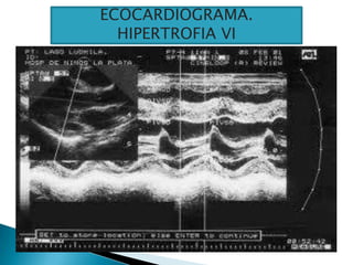 ECOCARDIOGRAMA.
HIPERTROFIA VI
 