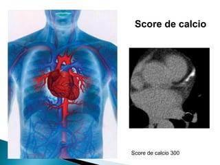 Score de calcio
Score de calcio 300
 